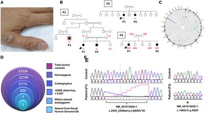 Novel CARMIL2 Mutations in Patients with Variable Clinical Dermatitis, Infections, and Combined Immunodeficiency